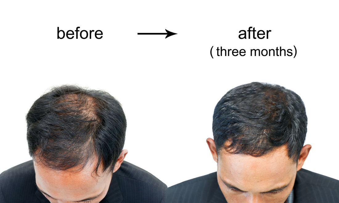 Can Bald Men Grow Hair? Insights into Possibilities and Treatments