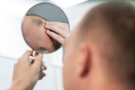 Unraveling the Genetics of Baldness: Heredity and Male Pattern Baldness Explained