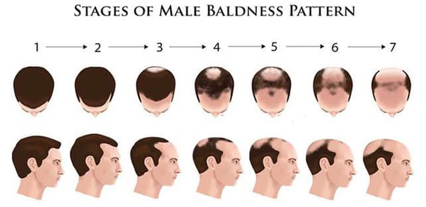 Unraveling the Genetics of Baldness: Heredity and Male Pattern Baldness Explained